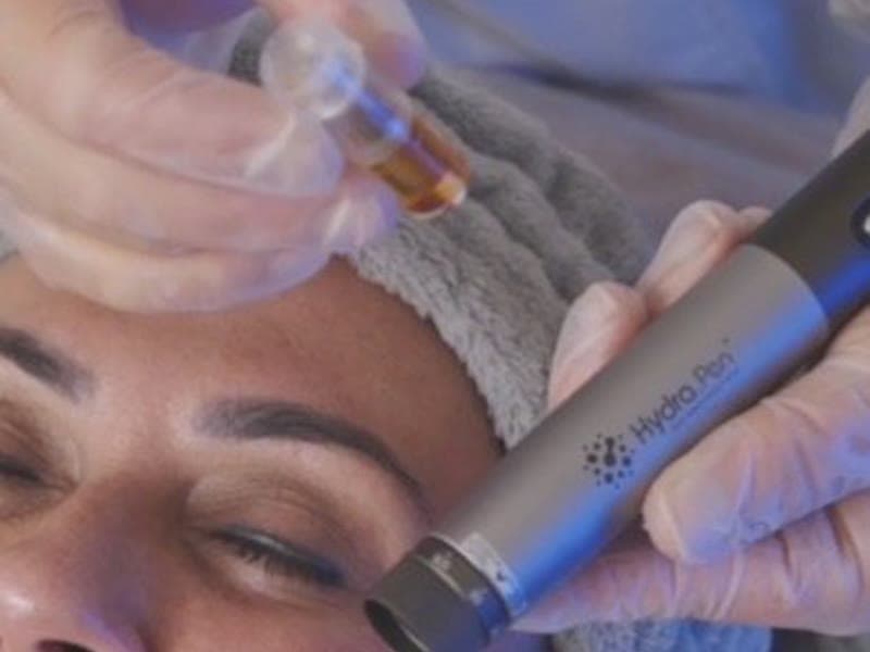 Add-On: Microneedling Convencional (Dr Pen / Hydrapen)