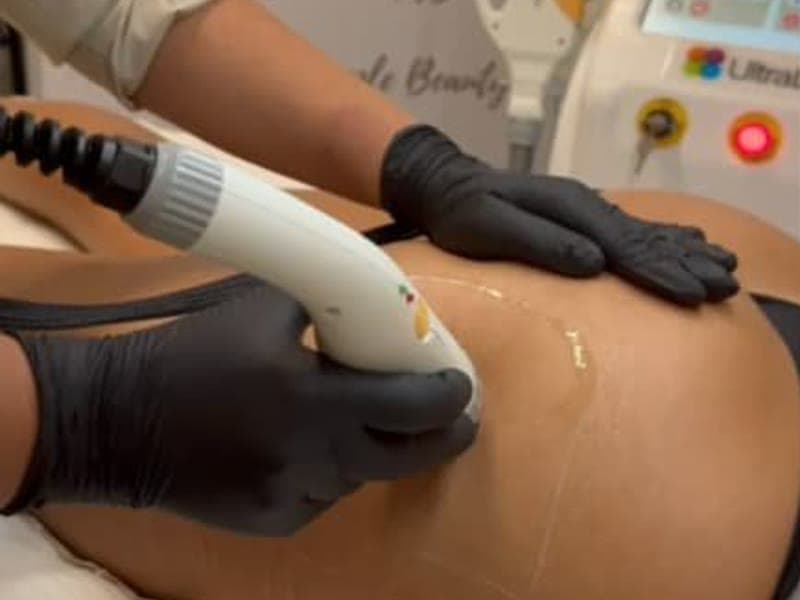 Brazilian Butt Lift (Non-Invasive)