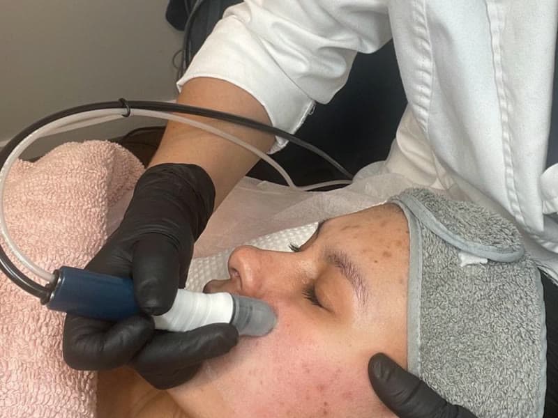 Deep Microdermabrasion (Derma-Pod Tech)
