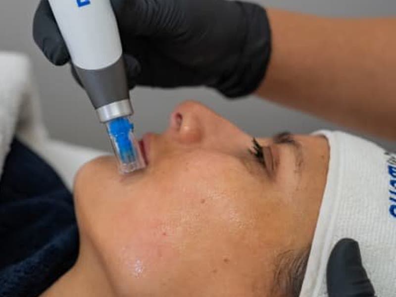 Repair and Glow — Microneedling (Dr. Pen)