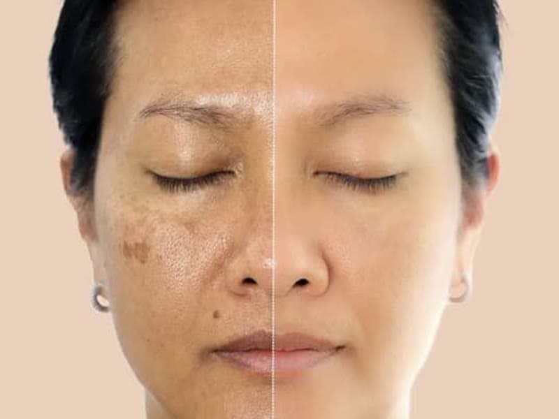 Sun Damage & Pigmentation — Small (Chin)