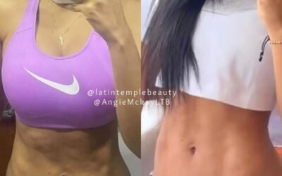 Tummy Tuck RF Lymphatic drainage masssage