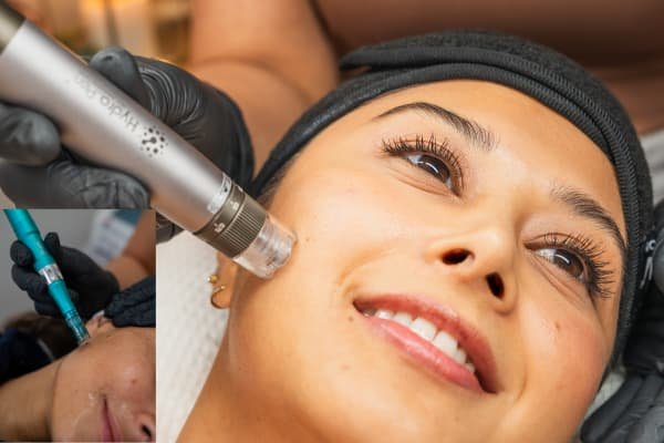 Add-on Microneedling