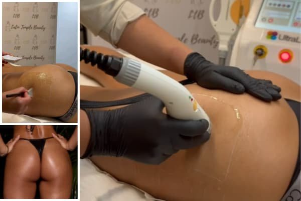 Brazilian Butt Lift (Non-Invasive)