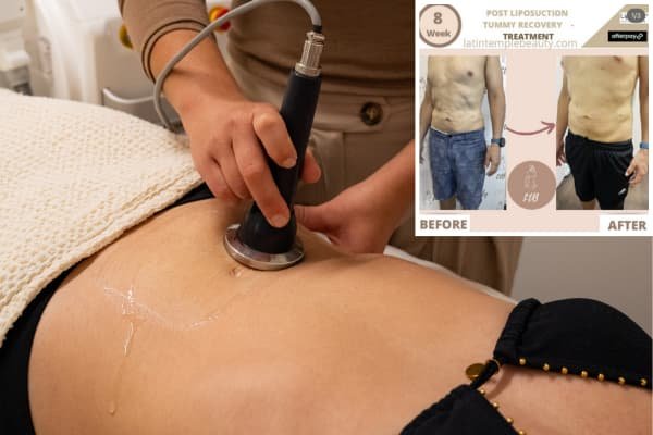 Post-Liposuction + RF + Lymphatic Drainage