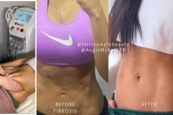 Post-Liposuction + RF + Lymphatic Drainage