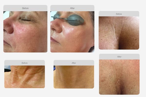 Fine Lines & Wrinkles – Face + Neck + Décolleté