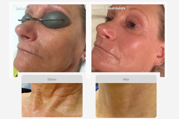 Fine Lines & Wrinkles – Face + Neck