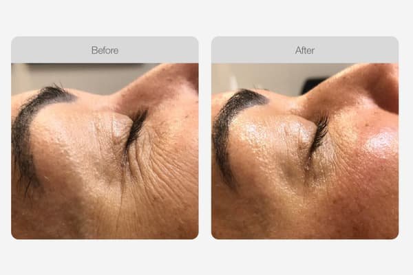 Fine Lines & Wrinkles – Full Face