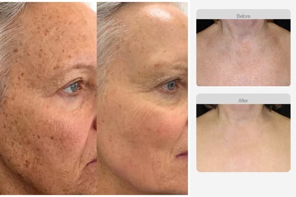 Sun Damage & Pigmentation – Large (Face, Neck, Décolleté)