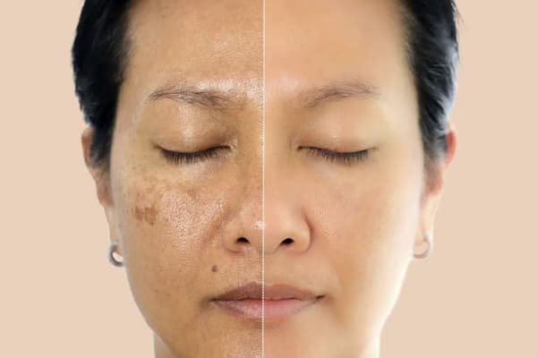 Sun Damage & Pigmentation – Medium (Cheek, Face)
