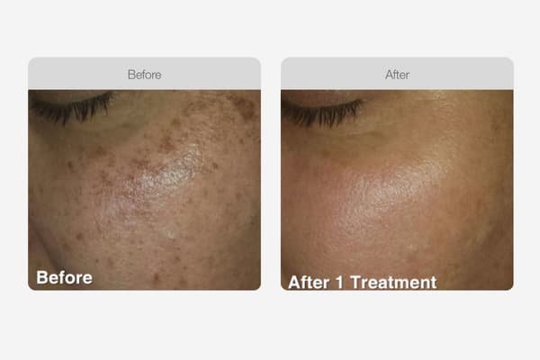 Sun Damage & Pigmentation – Small (Chin)