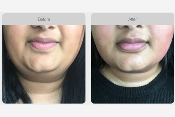Face + Neck + Décolleté Lifting (RF)