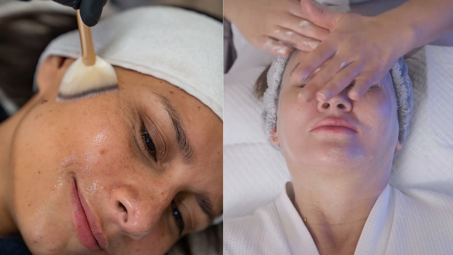 Add-on Microneedling – Dr Pen