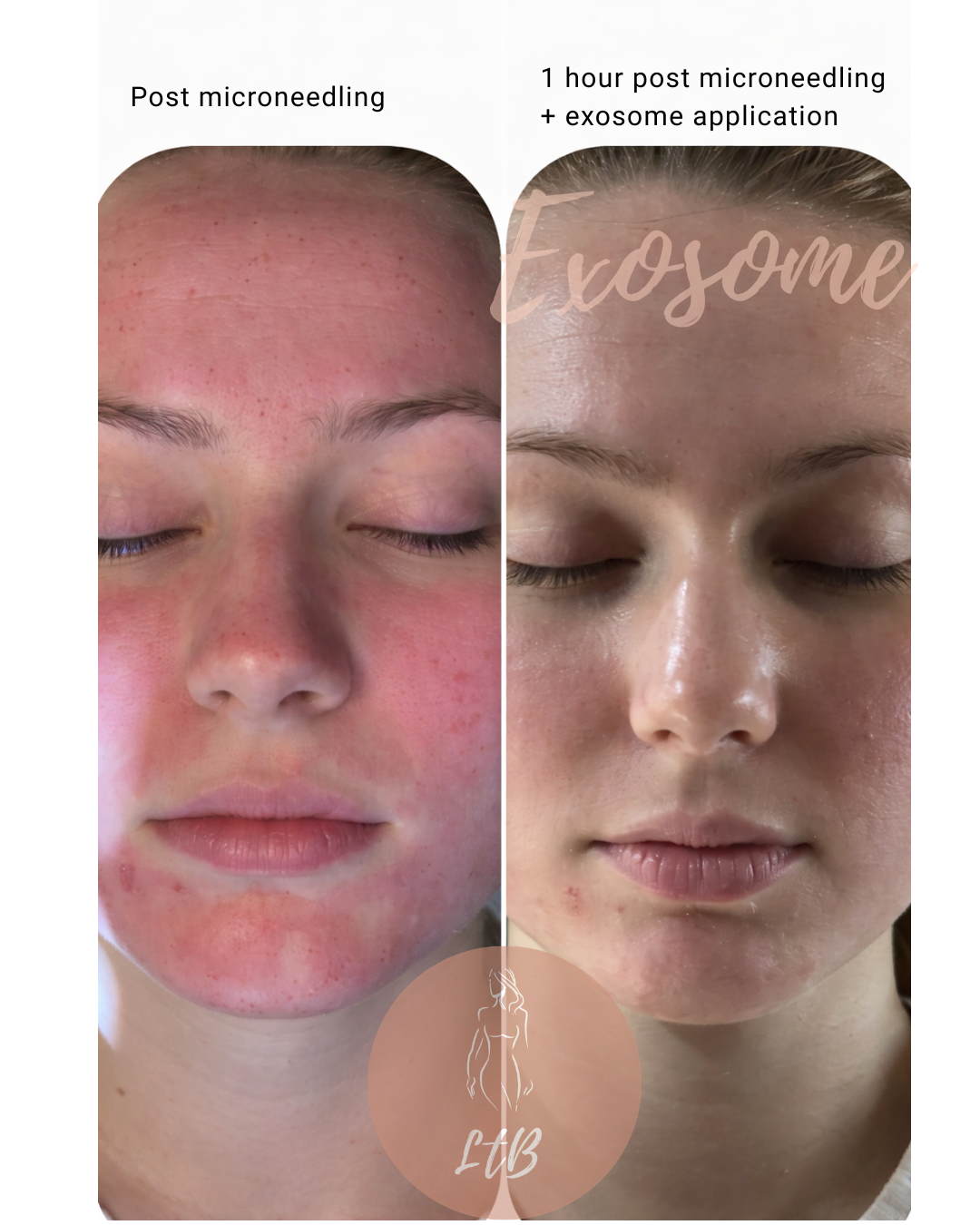 Post Microneedling vs 1 Hour Post Exosome Application