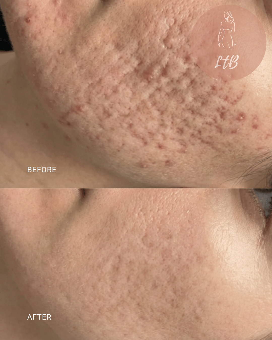 Before and After - Acne Scarring Close Up