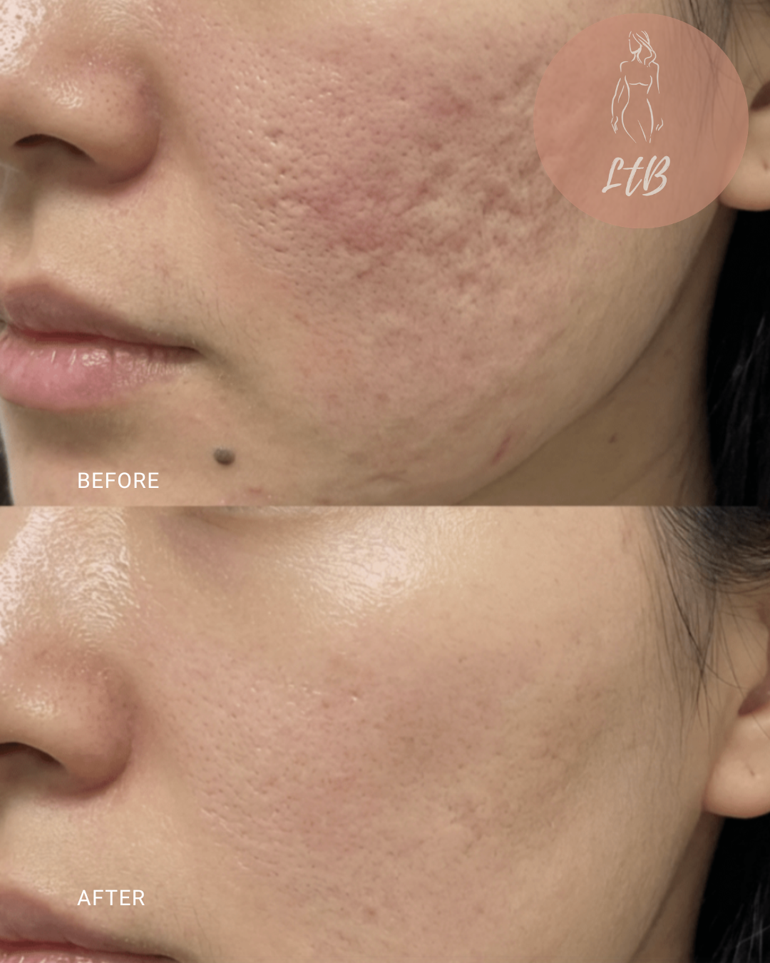 Before and After - Skin Texture Improvement