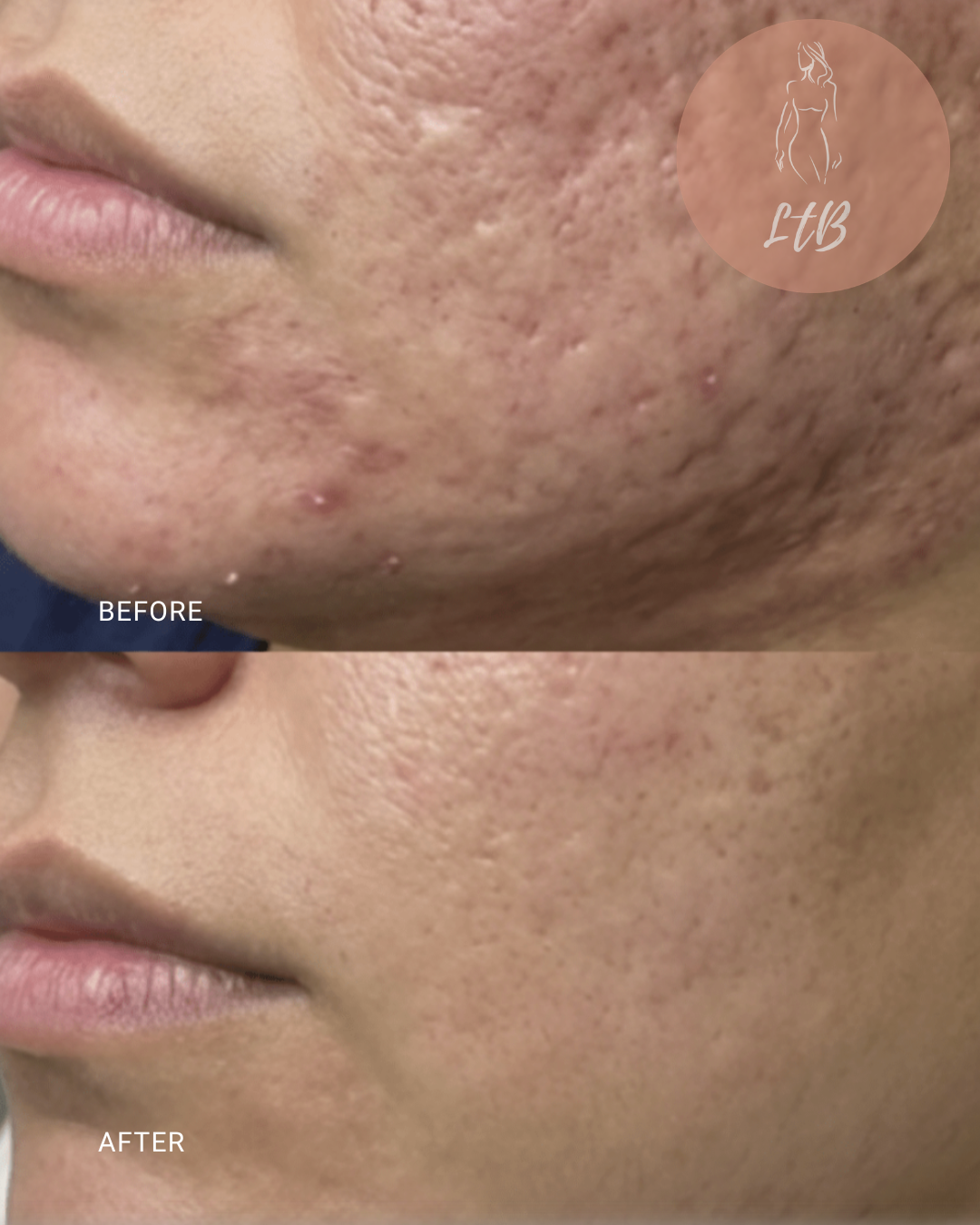 Before and After - Pore Refinement