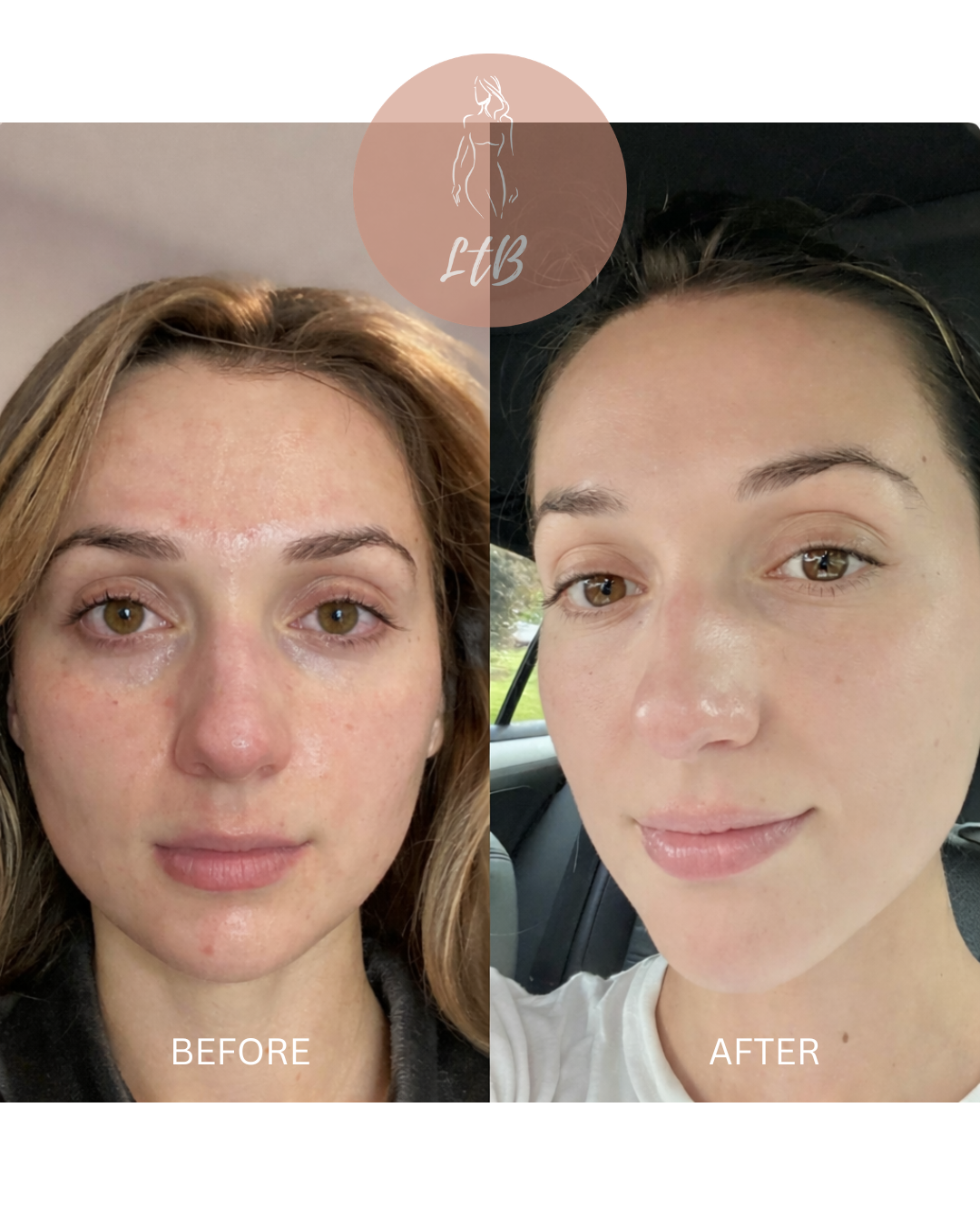 Before and After - Full Face Transformation